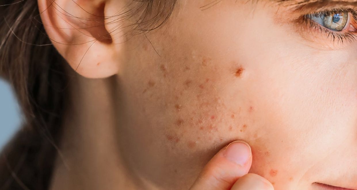 What Causes Adult Acne & Blemishes?