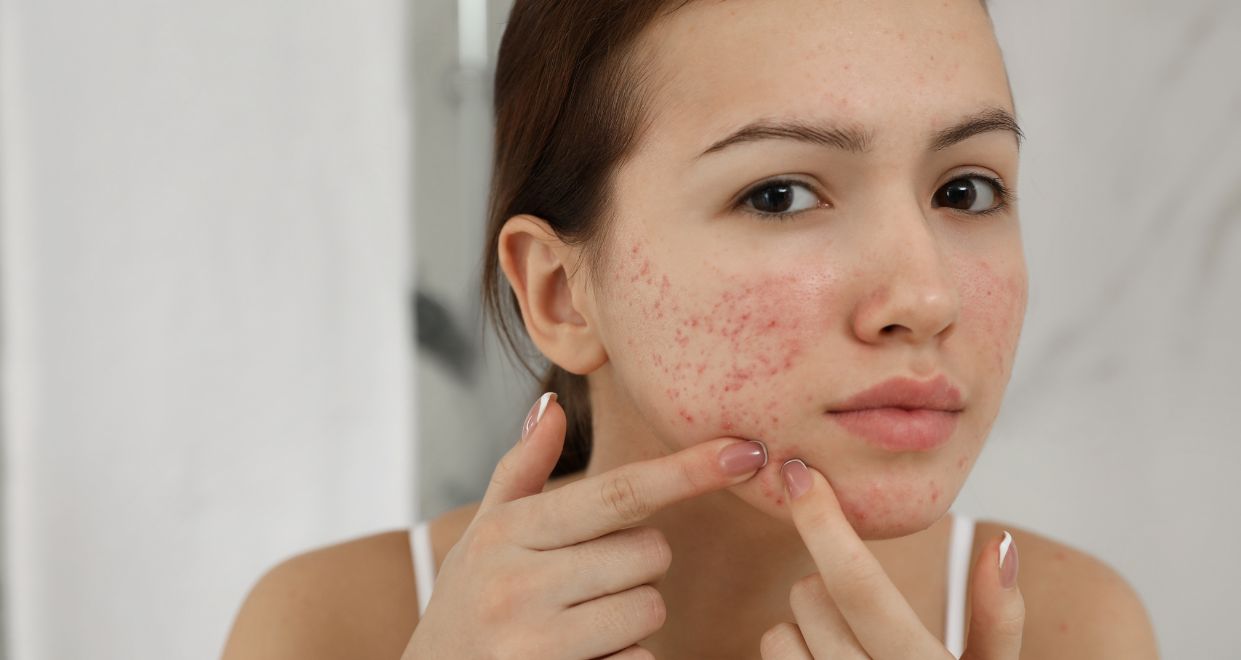 HOW TO GET RID OF ACNE & BLEMISHES