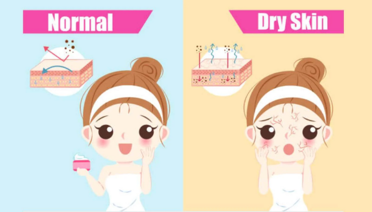 How to treat Dry Skin